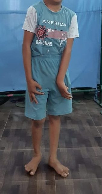 cerebral palsy treatment and surgery in kanpur